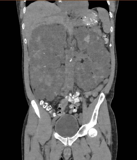 Coronal CT KUB in a man with haematuria.