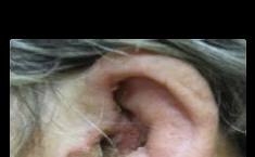 Clinical photograph of the left ear with discharge.