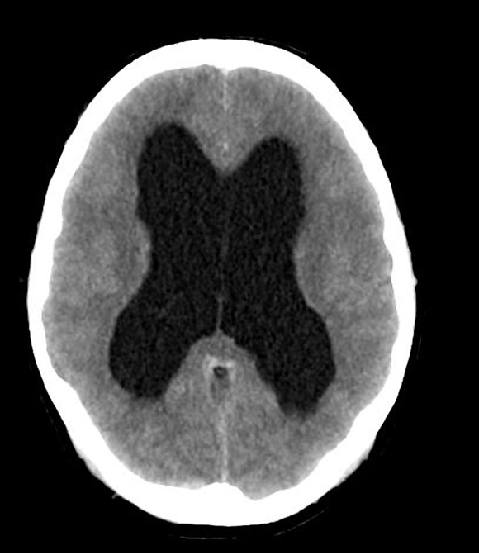 Axial CT brain after seizure during lumbar puncture.