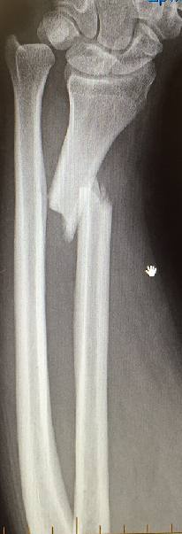 Wrist X-ray after fall onto an outstretched hand.