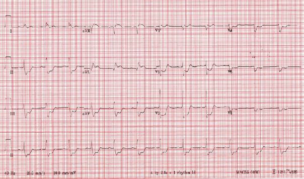 ECG after pre-hospital VF arrest.