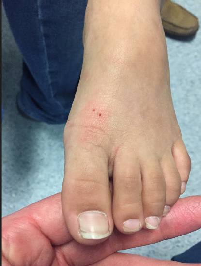Clinical photograph of a child's foot after an outdoor injury.