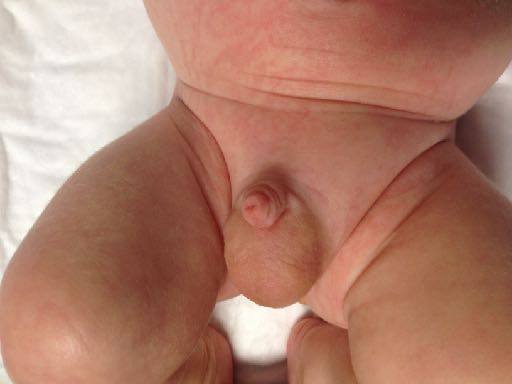 Clinical photograph of an infant groin lump.