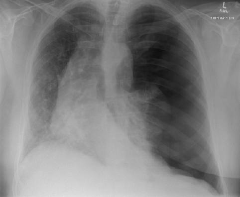 Chest X-ray after deterioration on non-invasive ventilation.