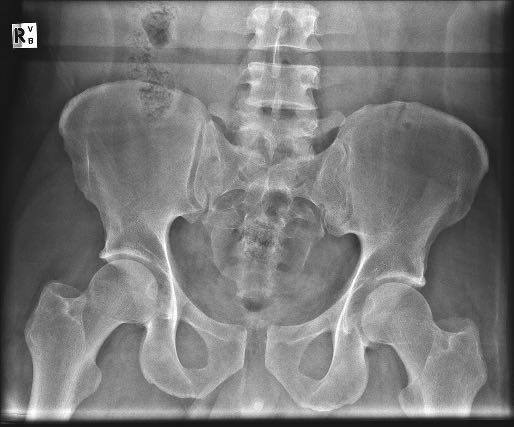 Pelvic X-ray after motorcycle crash.