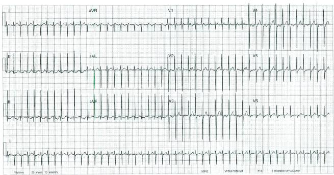 ECG in a 12-day-old infant with poor feeding and respiratory distress.