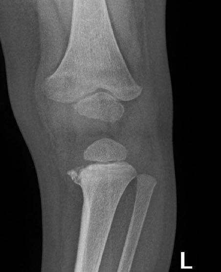 Leg X-ray in a toddler refusing to weight bear.