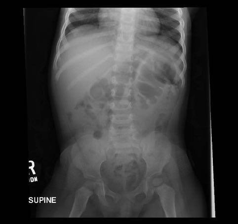 Abdominal X-ray in a toddler with intermittent abdominal pain.