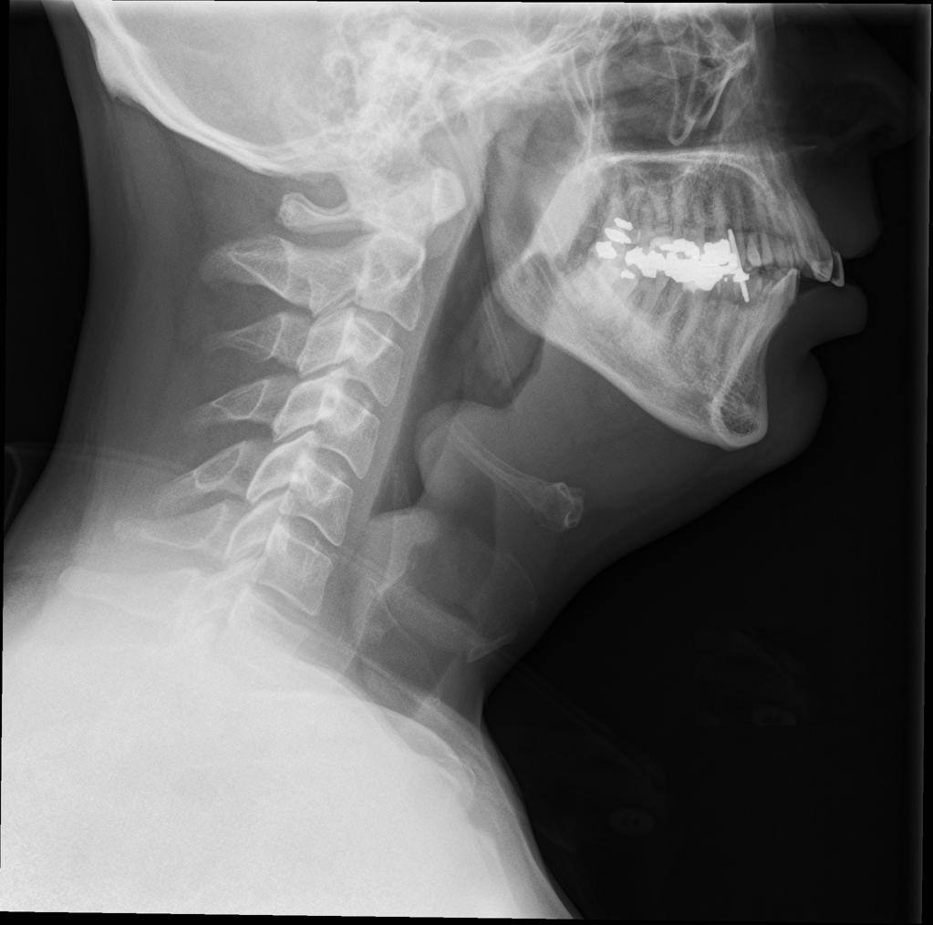 Lateral neck X-ray in a patient with sore throat and fever.
