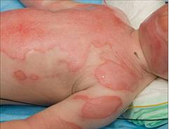 Clinical photograph of a paediatric anterior trunk and upper limb scald burn.