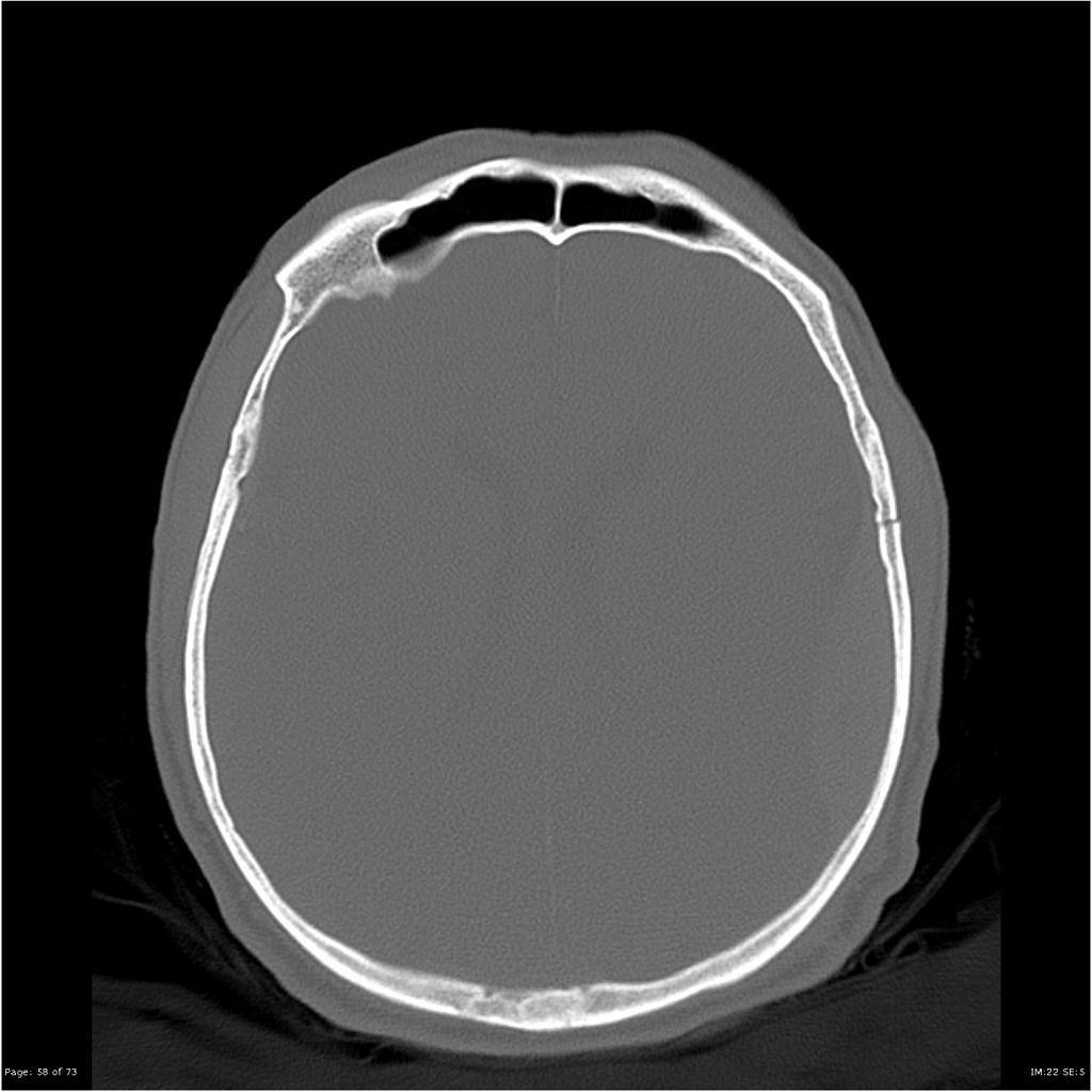 Axial CT brain image after head trauma, bone window.