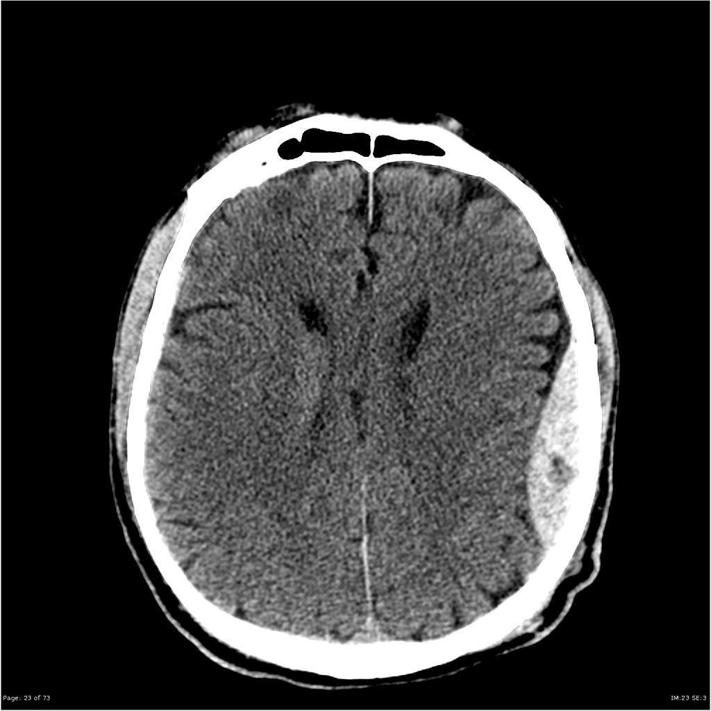 Axial CT brain image after head trauma, soft tissue window.