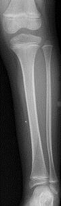 AP X-ray of a toddler's left lower leg after refusing to weight bear.