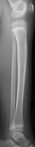Lateral X-ray of a toddler's left lower leg after refusing to weight bear.