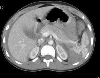 Axial CT abdomen image after blunt trauma with left upper quadrant injury.
