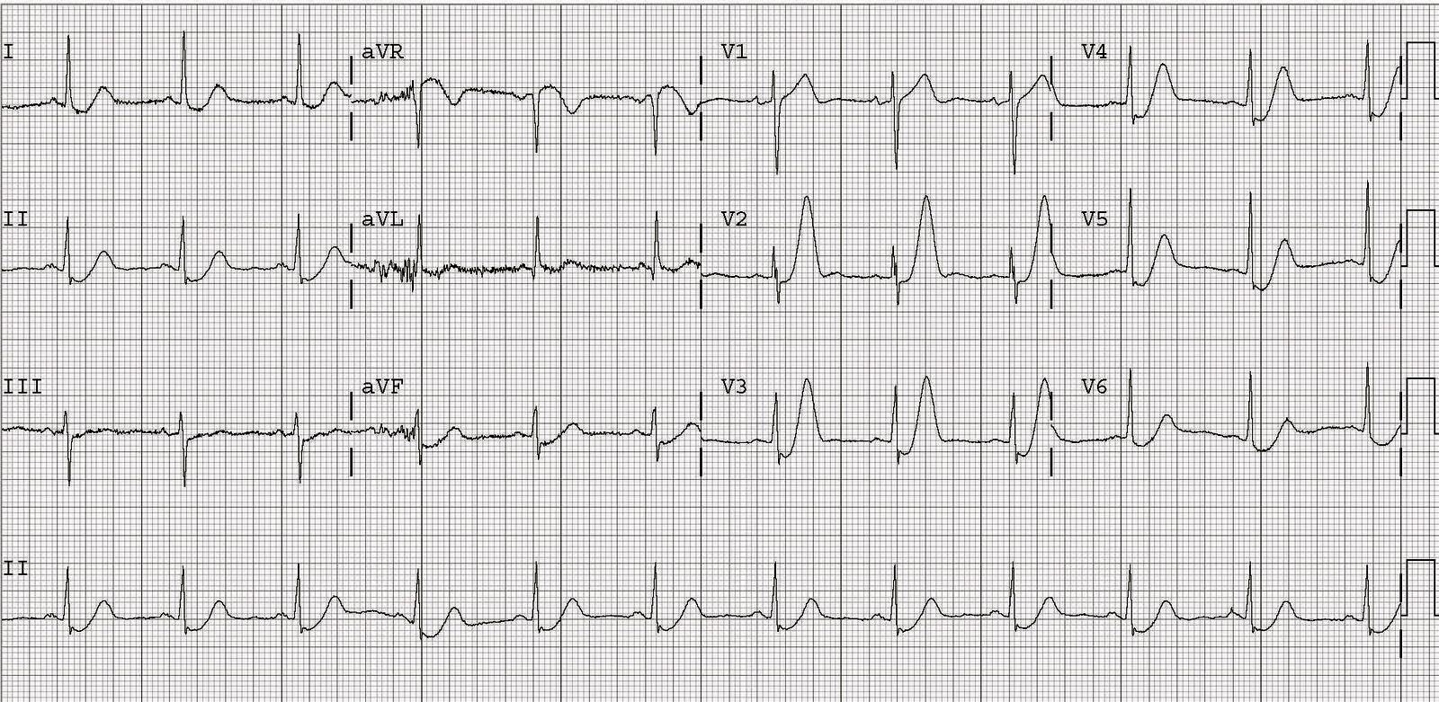 12-lead ECG in a 40-year-old man with ongoing chest pain.