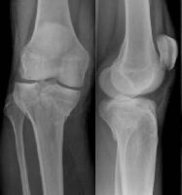 AP and lateral knee X-rays after a fall from a truck.
