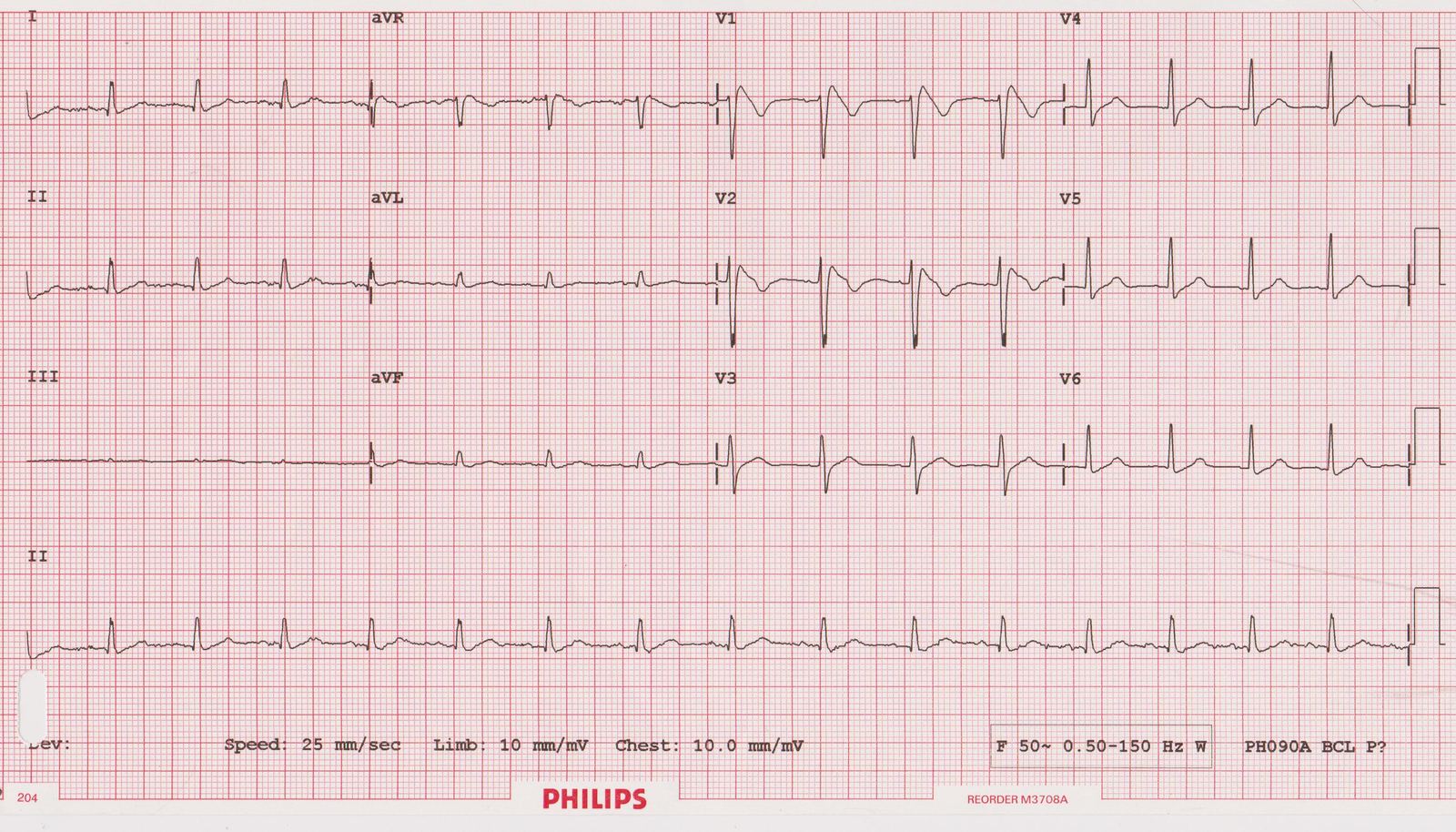 12-lead ECG in a young man presenting after syncope.