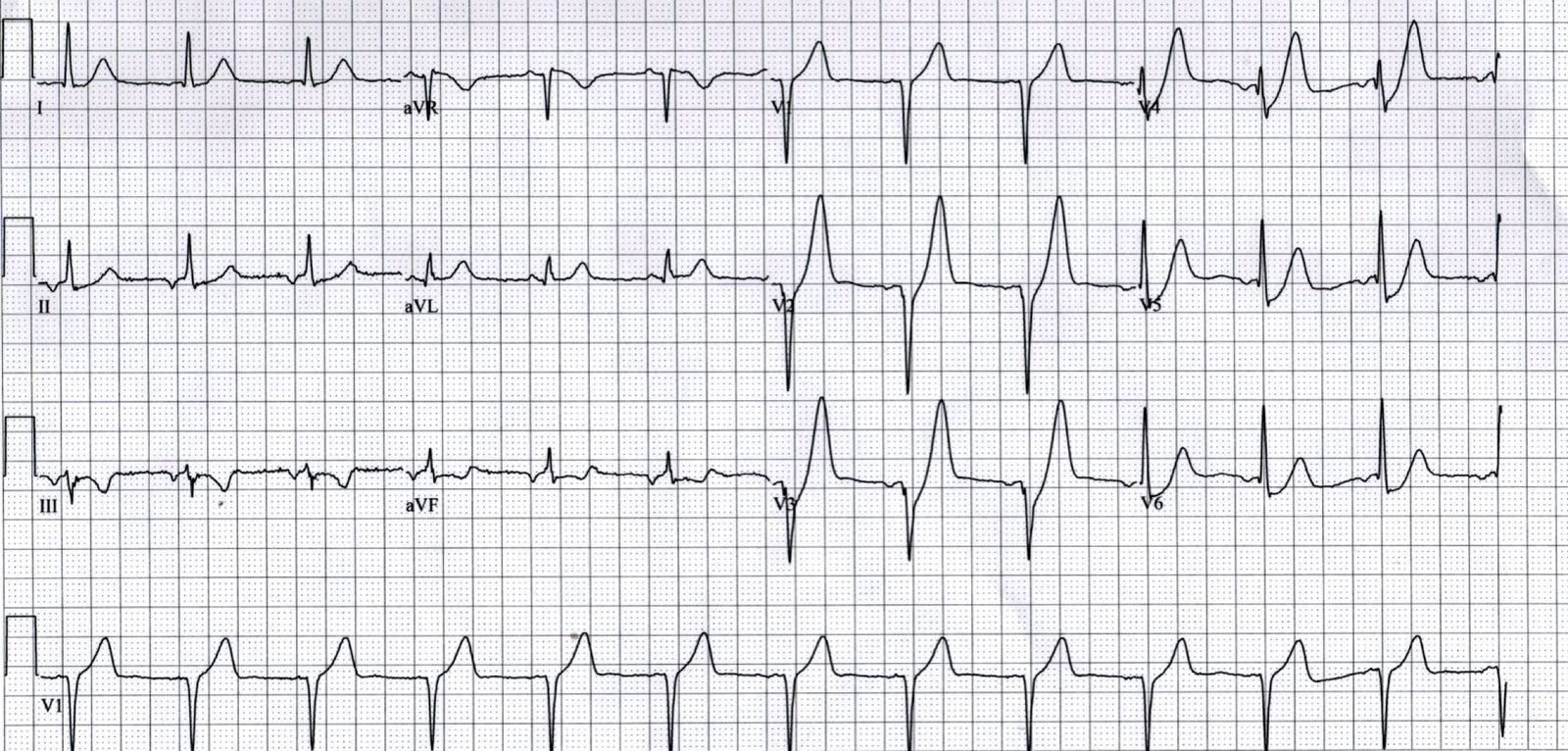 12-lead ECG for a 52-year-old man with ongoing ischaemic chest pain.