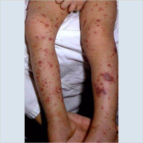 Clinical photograph of a purpuric rash on a child's legs.