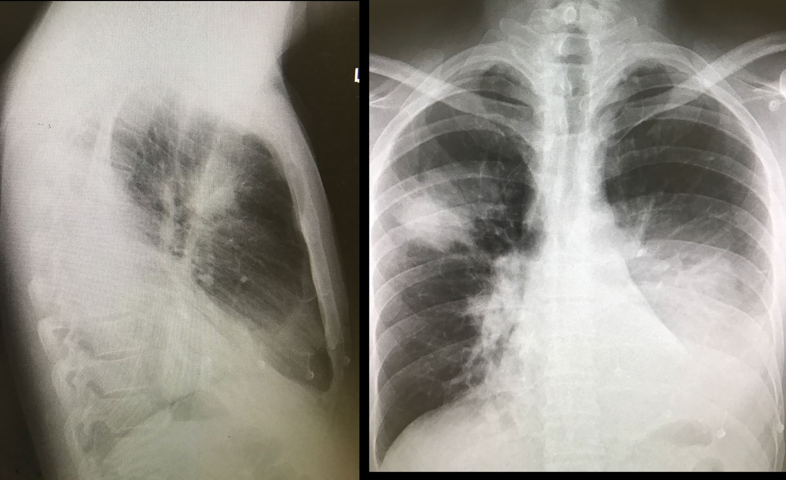 PA and lateral chest X-rays in a man with dyspnoea after influenza B.