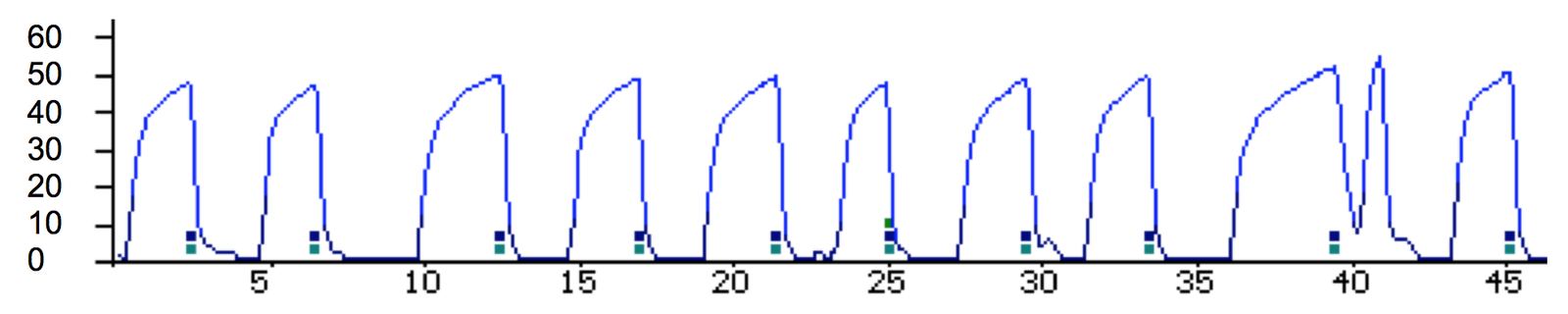Ventilator waveform trace from an intubated patient.