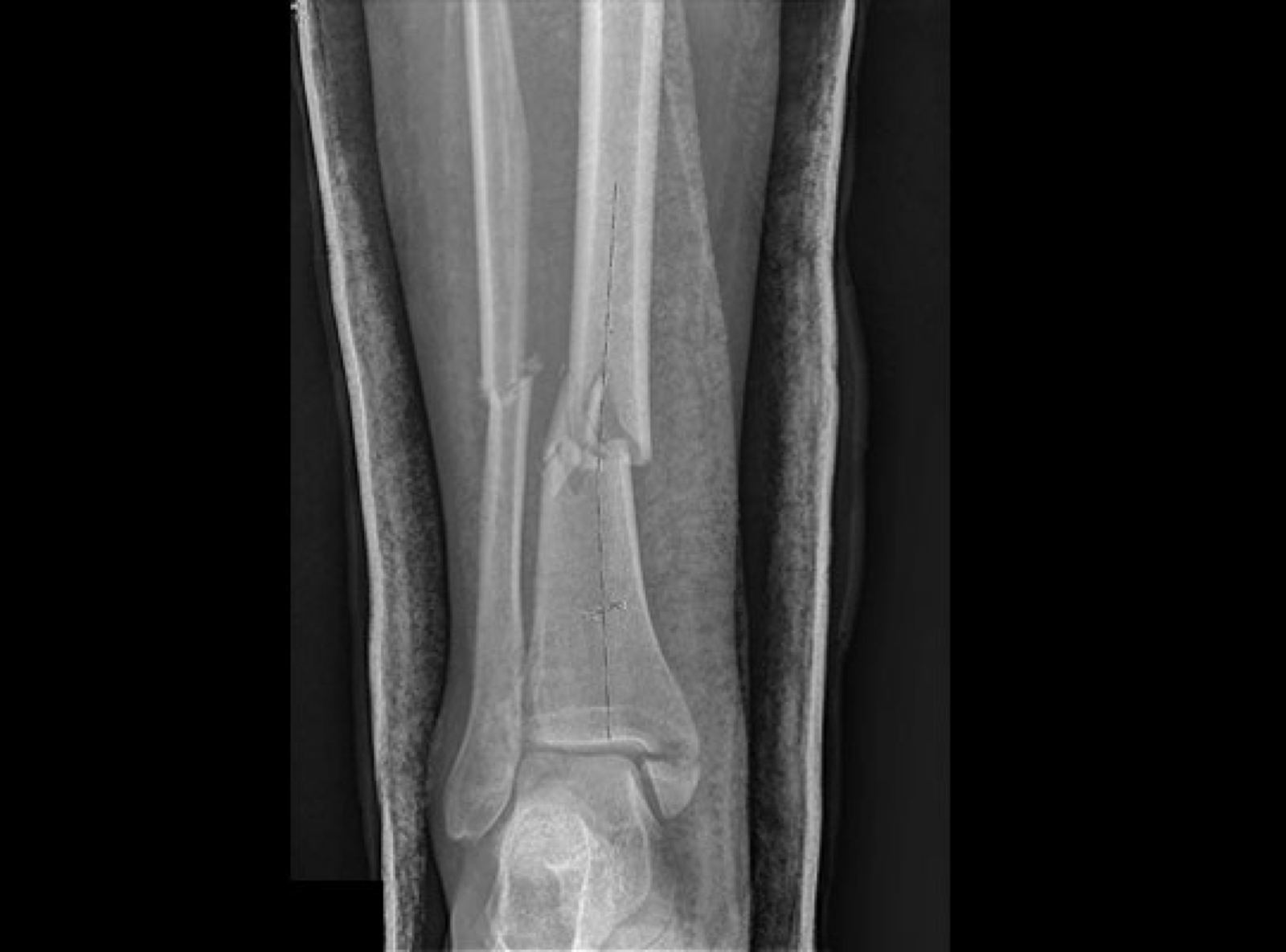 Lower limb X-ray after a soccer tackle injury.