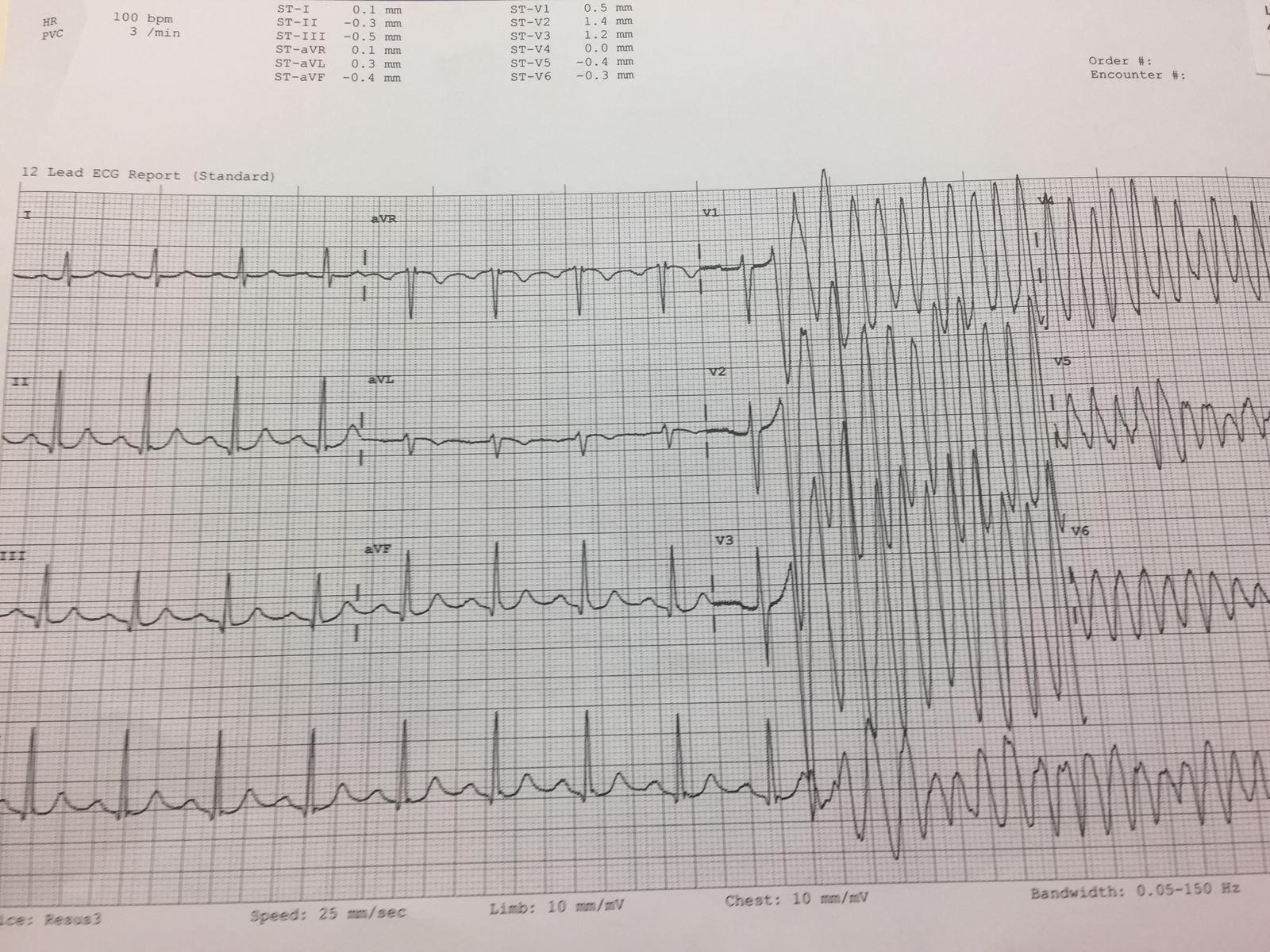 12-lead ECG captured as a patient loses consciousness with chest pain.