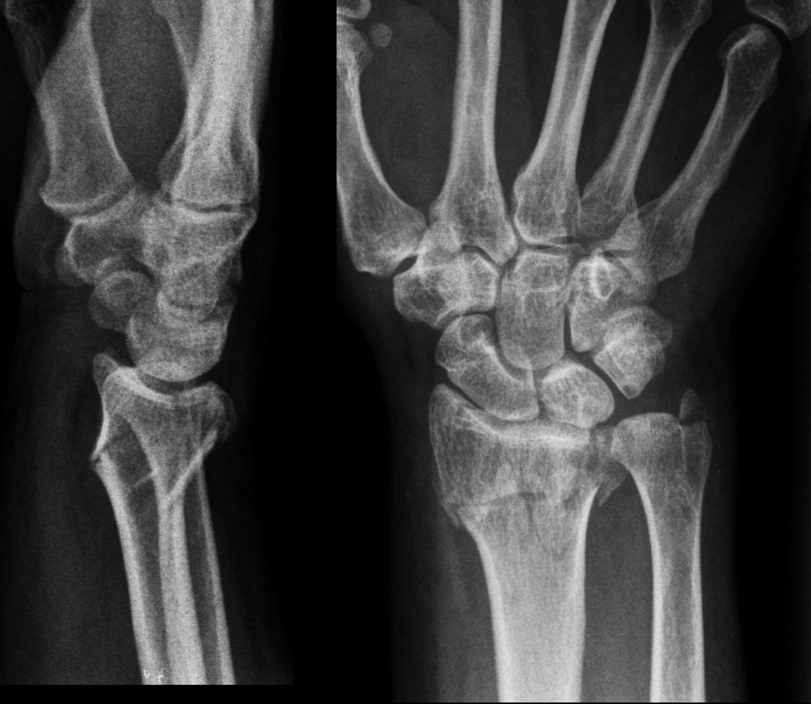 AP and lateral wrist X-rays after a fall.