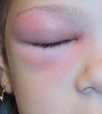 Right peri-orbital swelling and erythema in a febrile child.