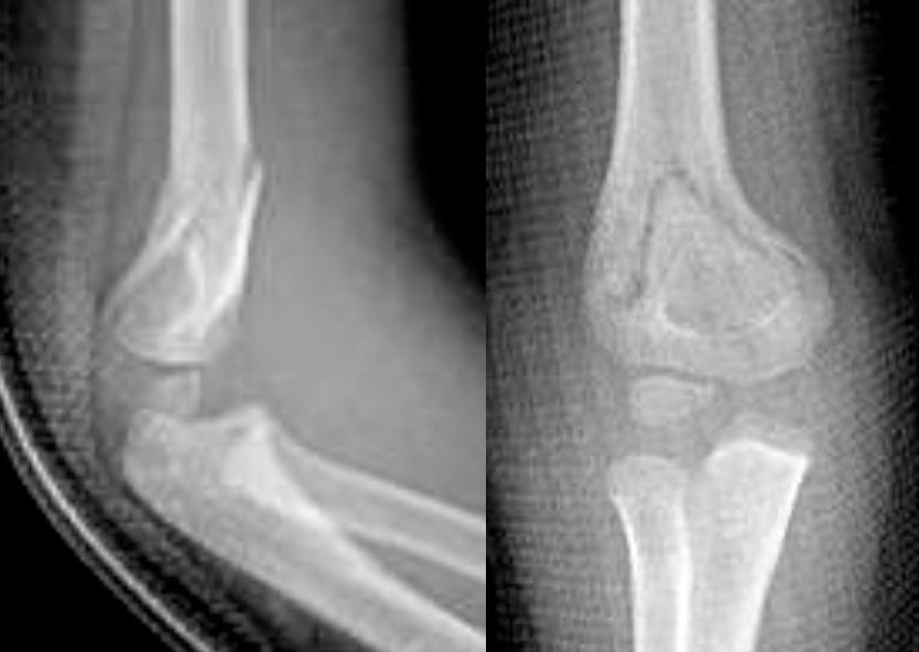 AP and lateral elbow X-rays after a hyperextension injury in a child.