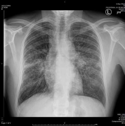 Chest X-ray for a young non-smoker with shortness of breath.