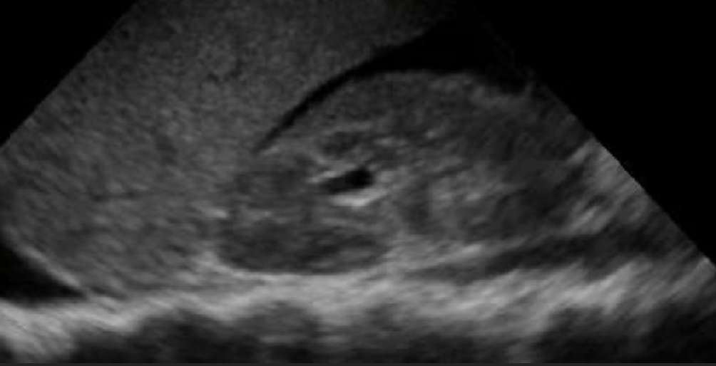 eFAST ultrasound still after blunt right-sided torso trauma.