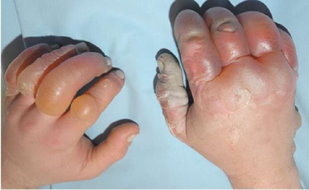 Photograph of both hands with frostbite injury.