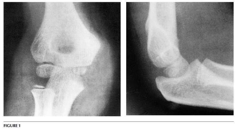 AP and lateral elbow X-rays after a fall from monkey bars.