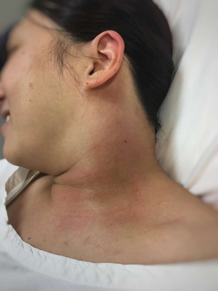 Photograph showing left neck swelling in a febrile adult.