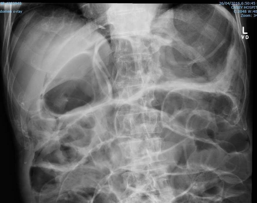 Abdominal X-ray in an older man with vomiting and shock.