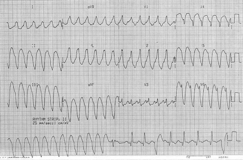 ECG showing a broad complex tachycardia.