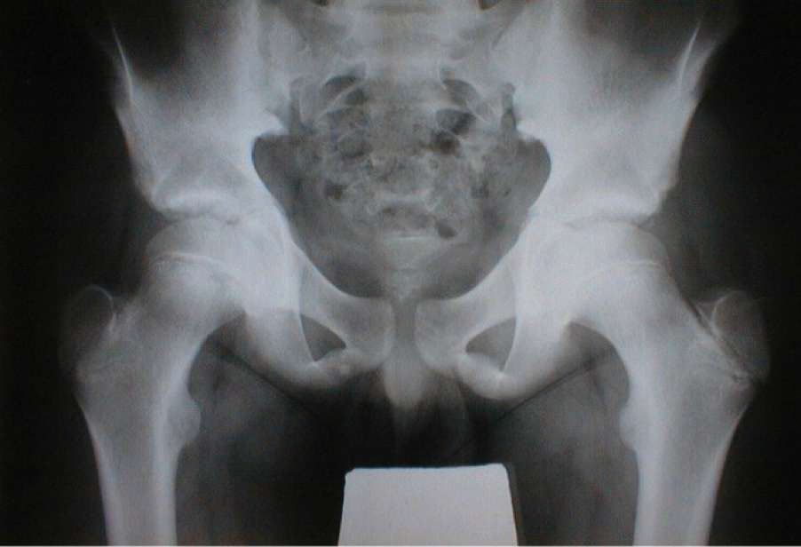 Pelvic X-ray in an 11-year-old boy with limp and hip pain.