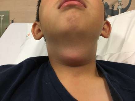 Anterior photograph of a child with neck swelling.