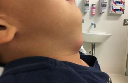 Lateral photograph of a child with neck swelling.