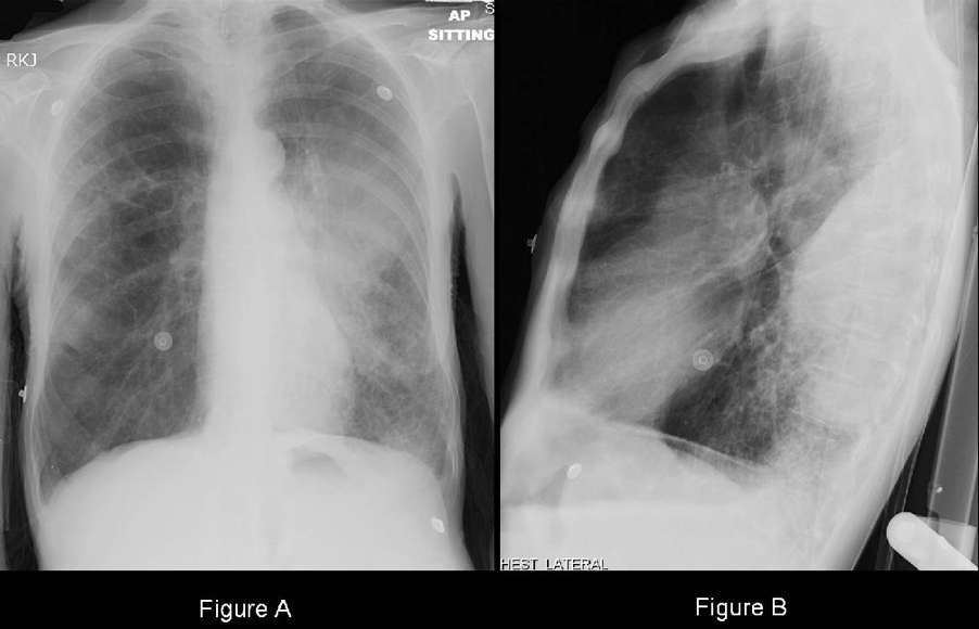 Chest X-ray in an older man with shortness of breath and fever.