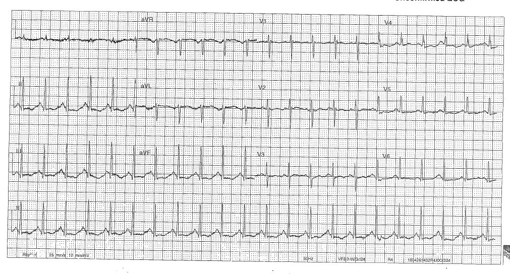 ECG in a young woman after mixed medication overdose.