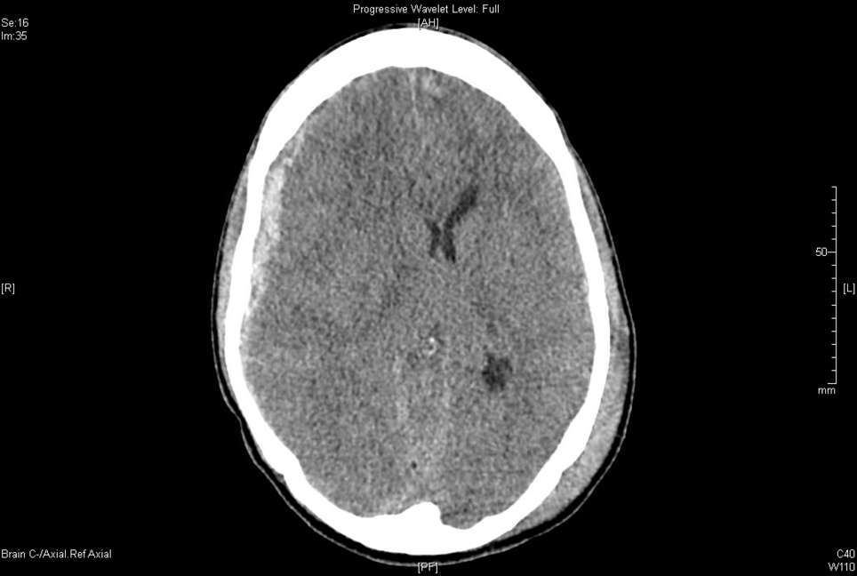 CT brain after a fall from height with subsequent fixed dilated pupil.