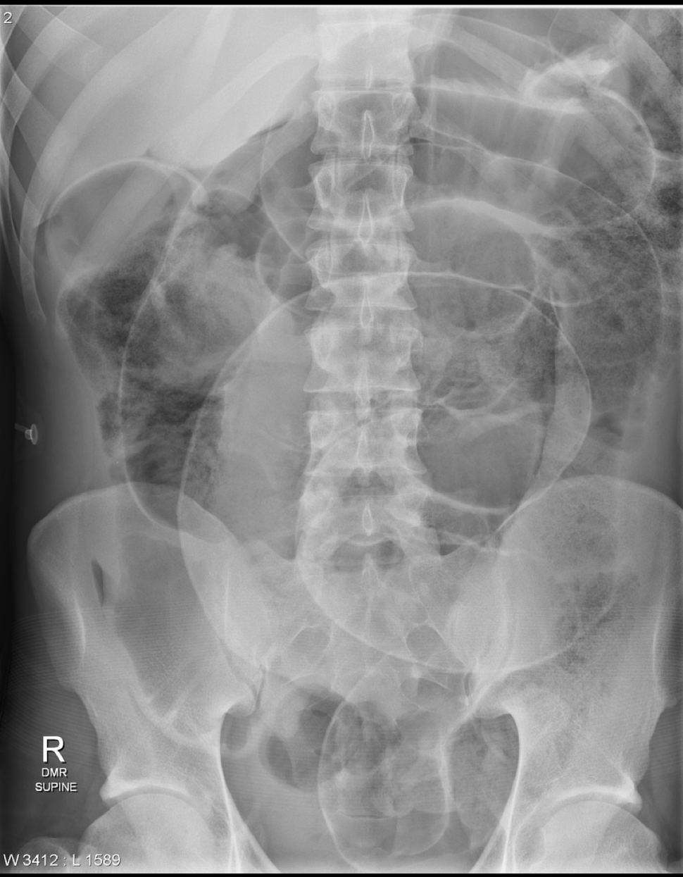 Abdominal X-ray in a patient with Crohn disease, severe abdominal pain, and fever.