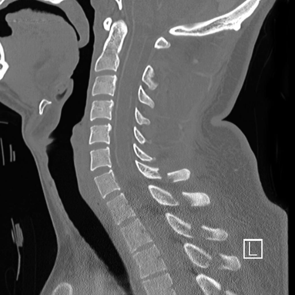 Sagittal cervical and upper thoracic CT image after a fall with limb weakness.