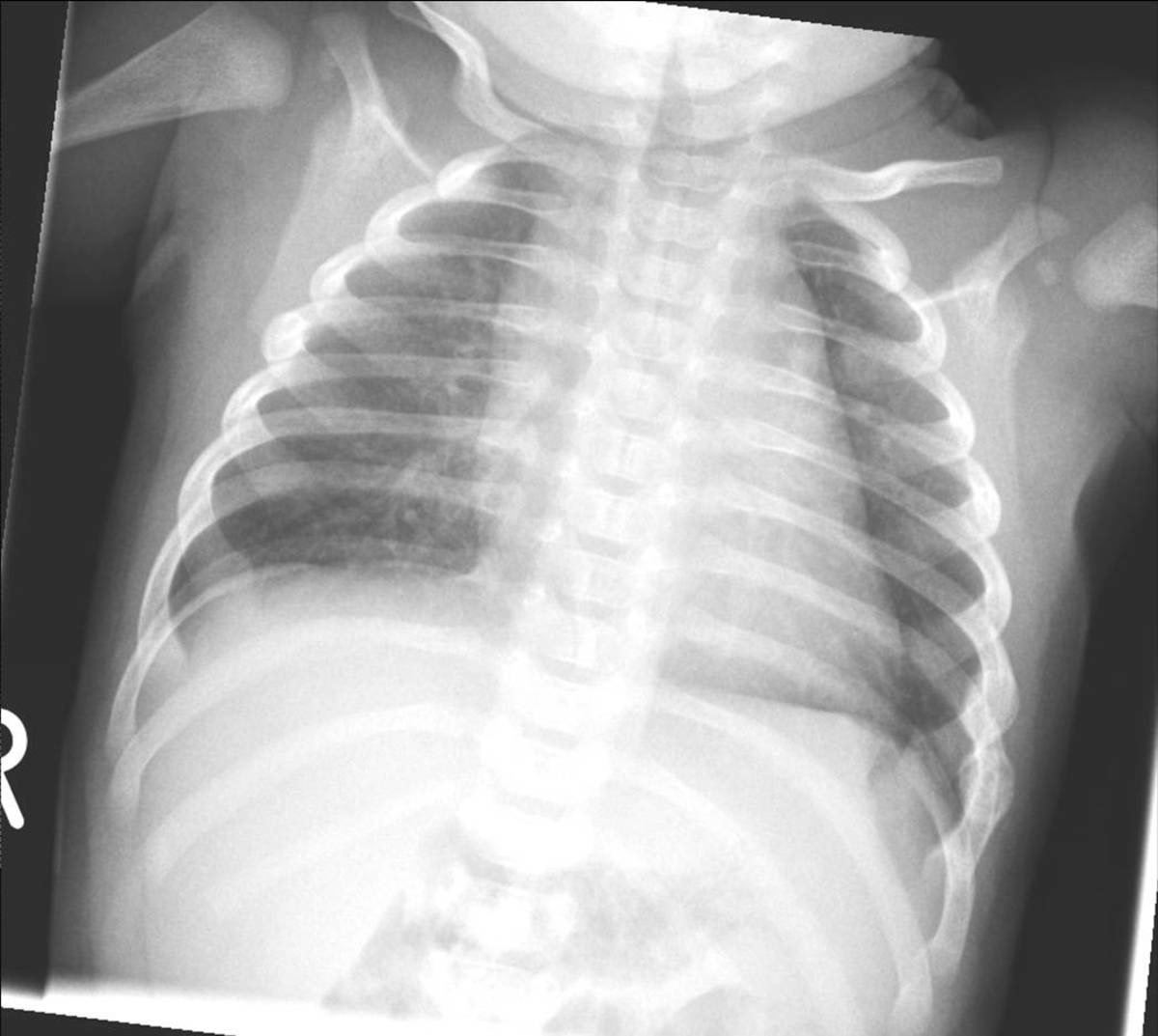 Chest X-ray in a 10-month-old infant with chest injury concern.
