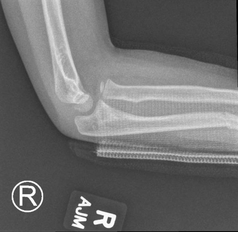 Lateral right elbow X-ray in a five-year-old with an isolated arm injury.