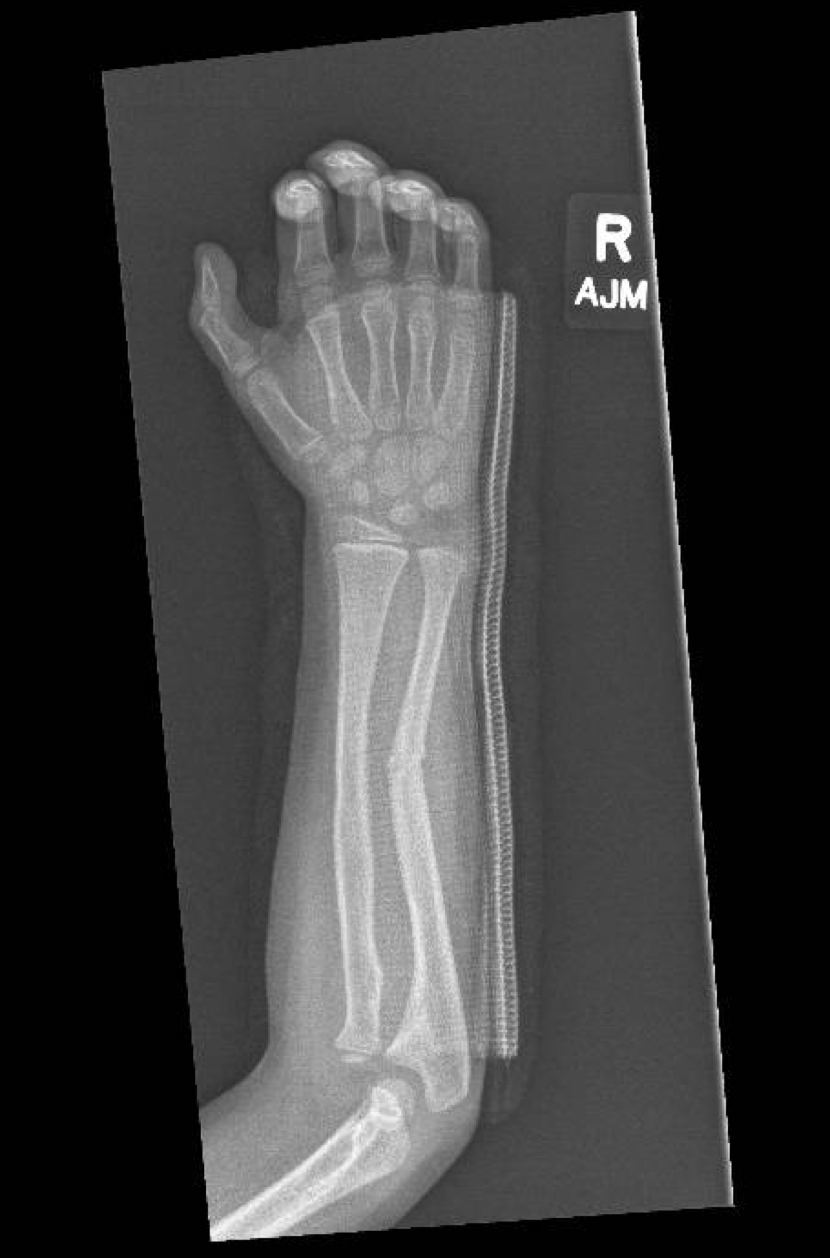 AP right forearm X-ray in a five-year-old with an isolated arm injury.