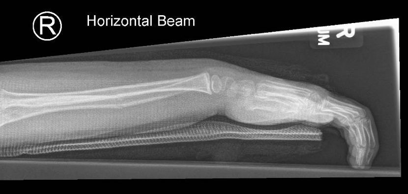 Horizontal beam lateral right forearm X-ray in a five-year-old with an isolated arm injury.